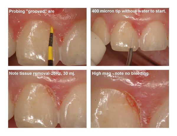 Gingivectomy and restoration Page2_resize.jpg